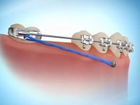 Mini-Implantes Ortodônticos